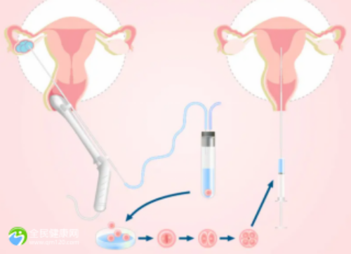 包成功助孕官网,子宫肌瘤试管婴儿怀孕？附影响因素分析！