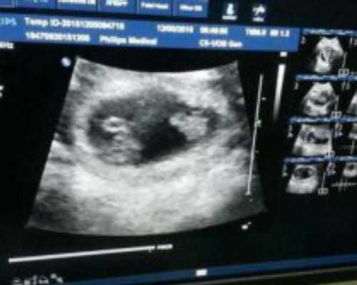 试管婴儿要来几次医院检查？试管婴儿要来几次医院检查好？